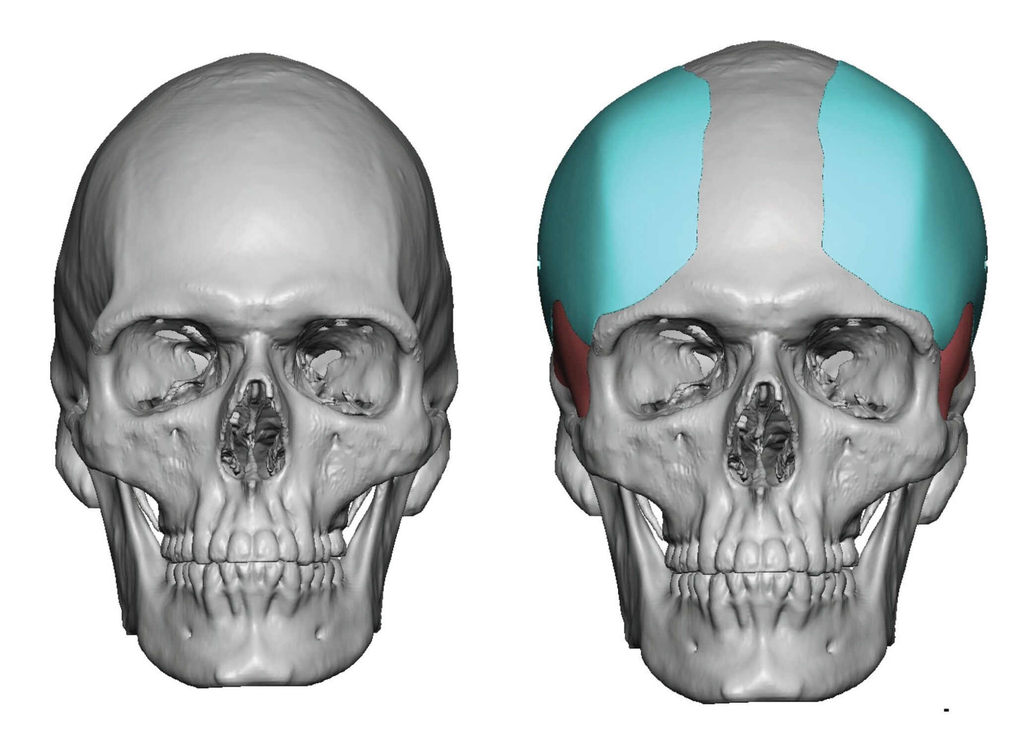 Custom Forehead Implants Eppley Custom Facial Implants