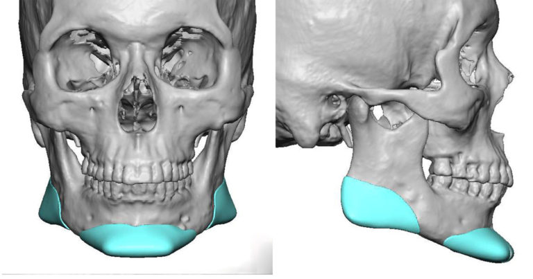 Custom Jaw Implants - Chin Implants 