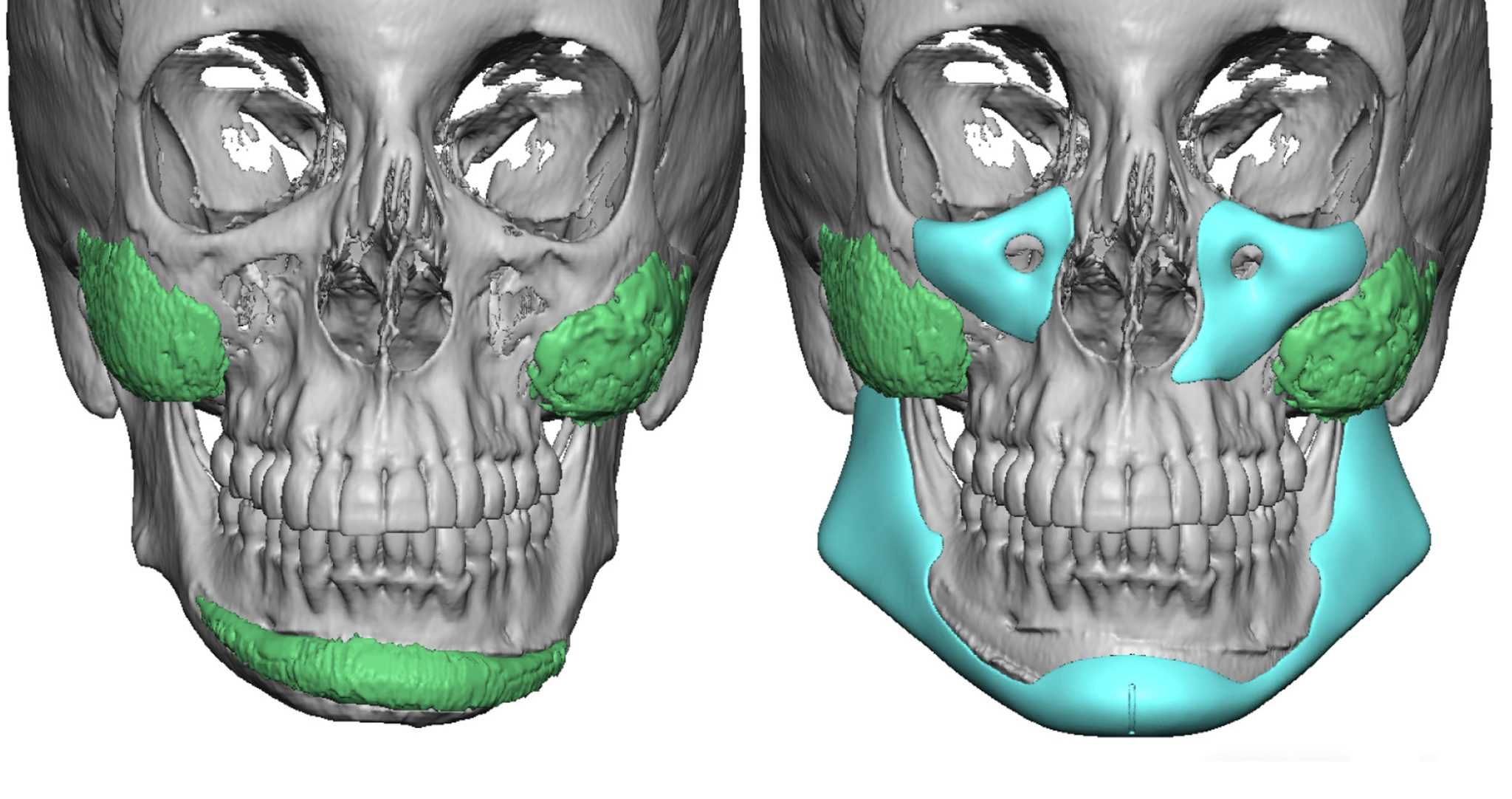 Custom Midface Implants - Cheek Implants | Eppley Custom Facial Implants