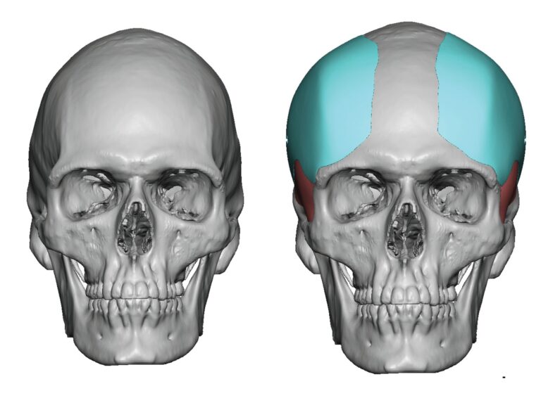 Custom Forehead Implants | Eppley Custom Facial Implants